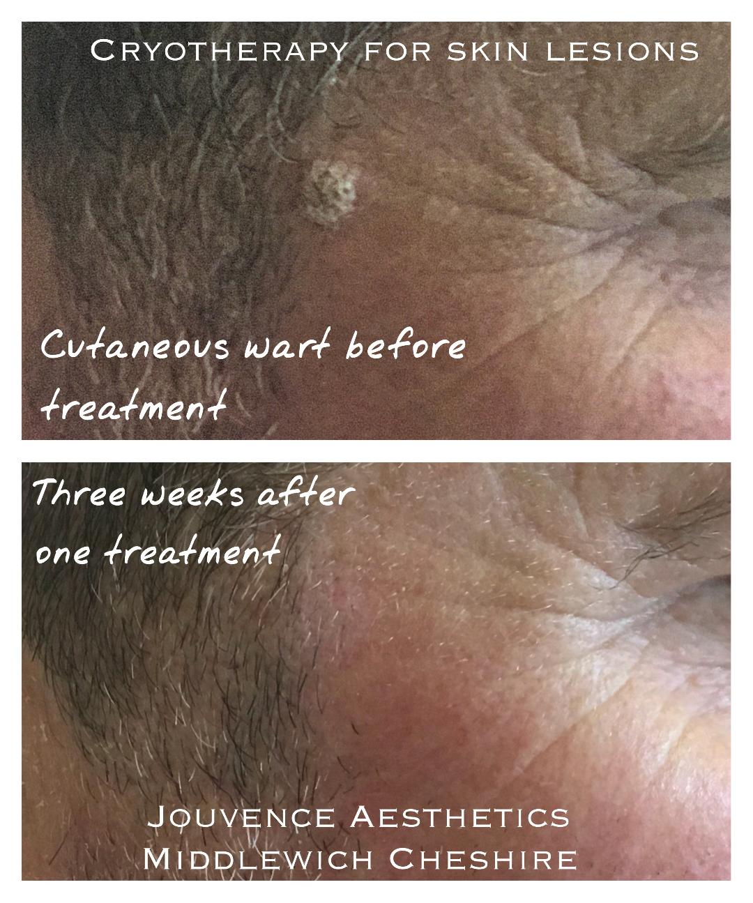 Seborrhoeic Keratosis /Wart Removal Cheshire