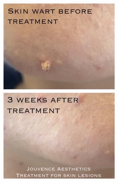Wart Treatments in Middlewich, Cheshire