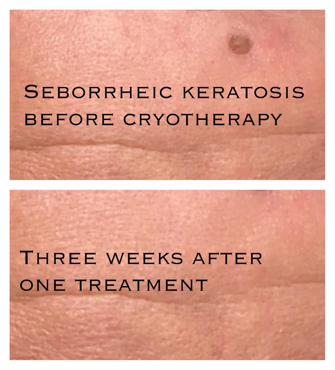Seborrheic Keratosis Treatment Apple Cider Vinegar Quotes Trendy
