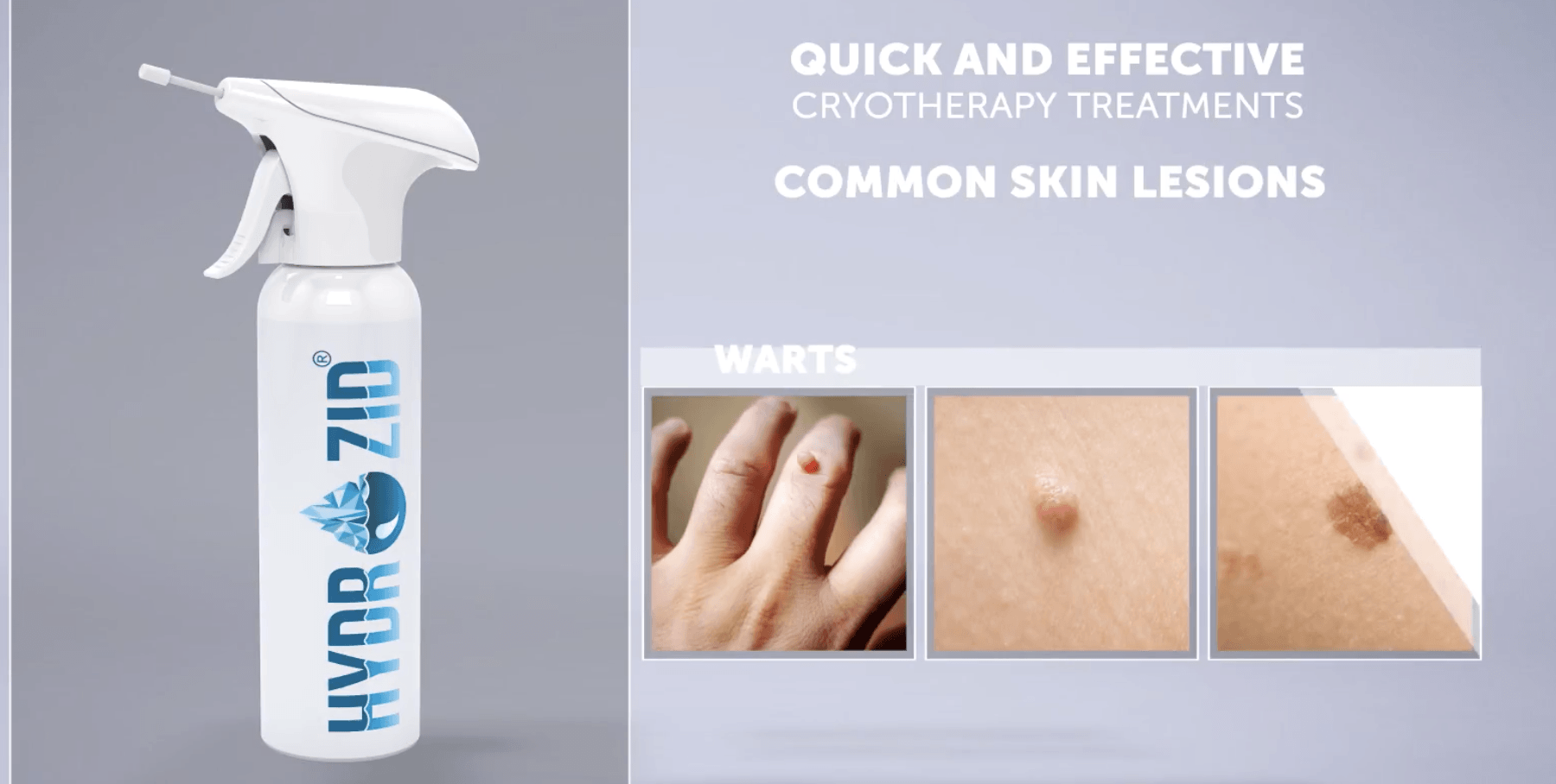 Cryotherapy treatments available at Cheshire Lasers Clinic Middlewich