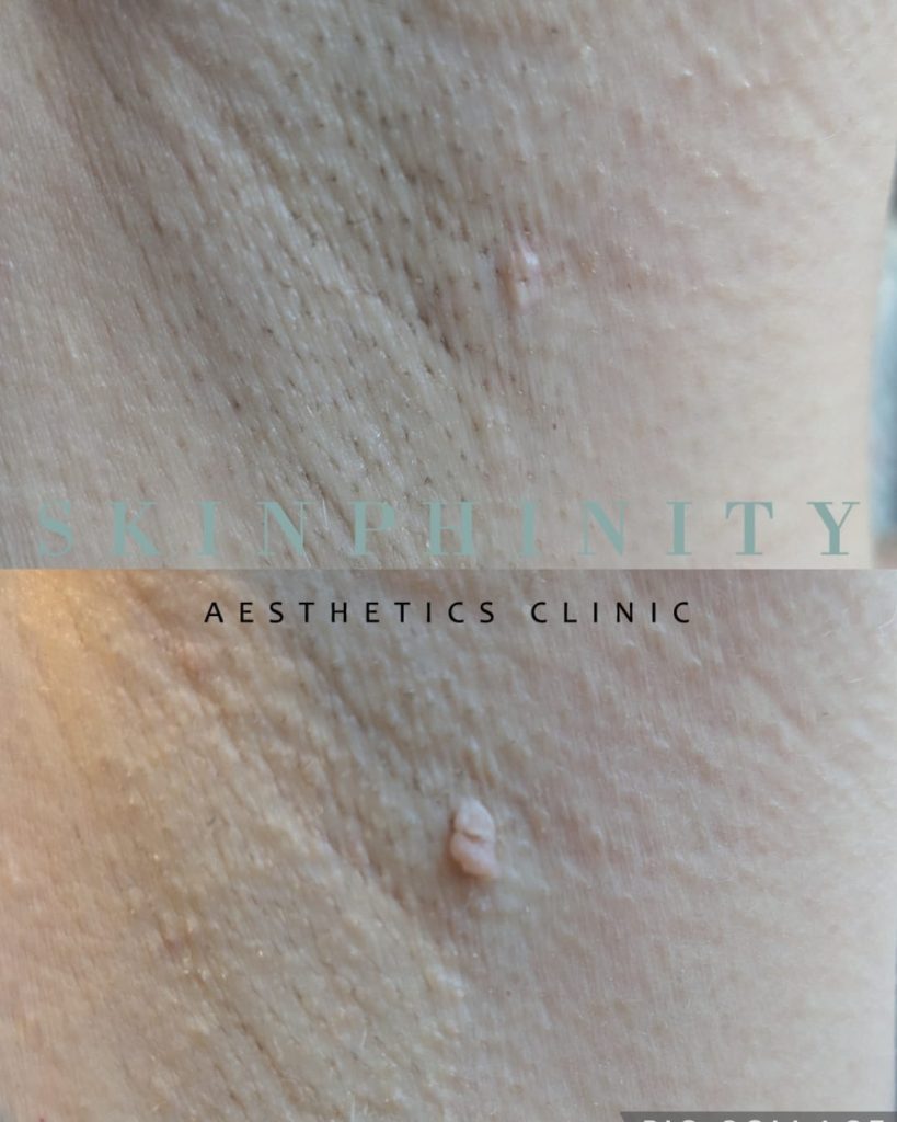 Before and after cryotherapy to a skin tag