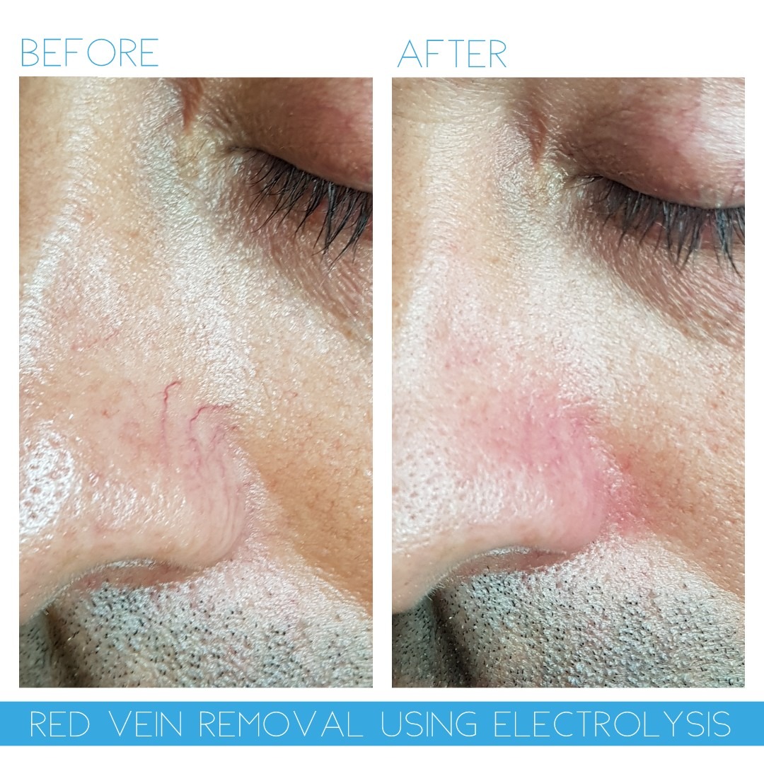 Advanced Electrolysis at Cheshire Lasers, Middlewich.