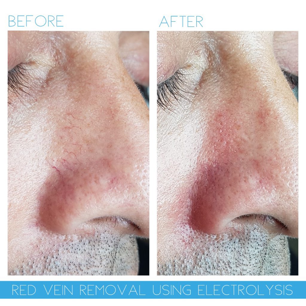 thread vein removal nose advanced electrolysis cheshire