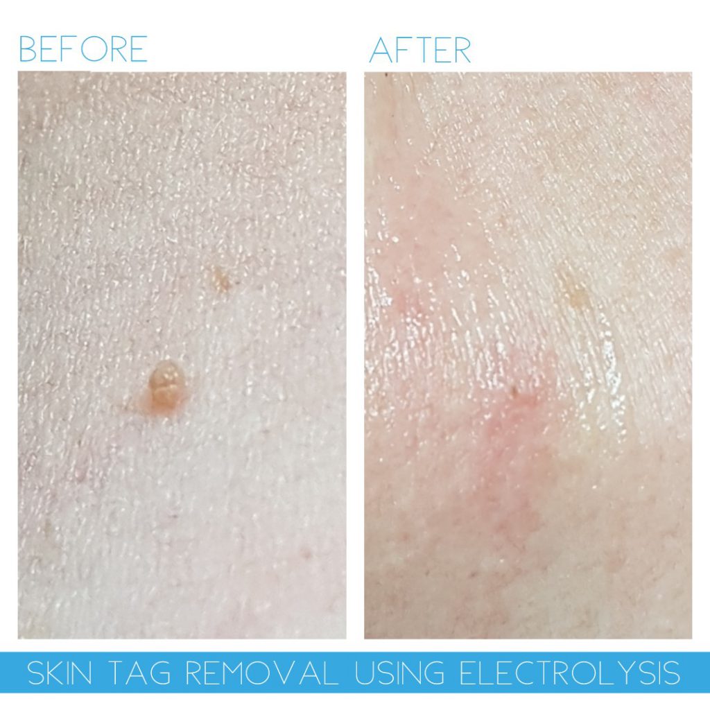 skin tag Cheshire removal