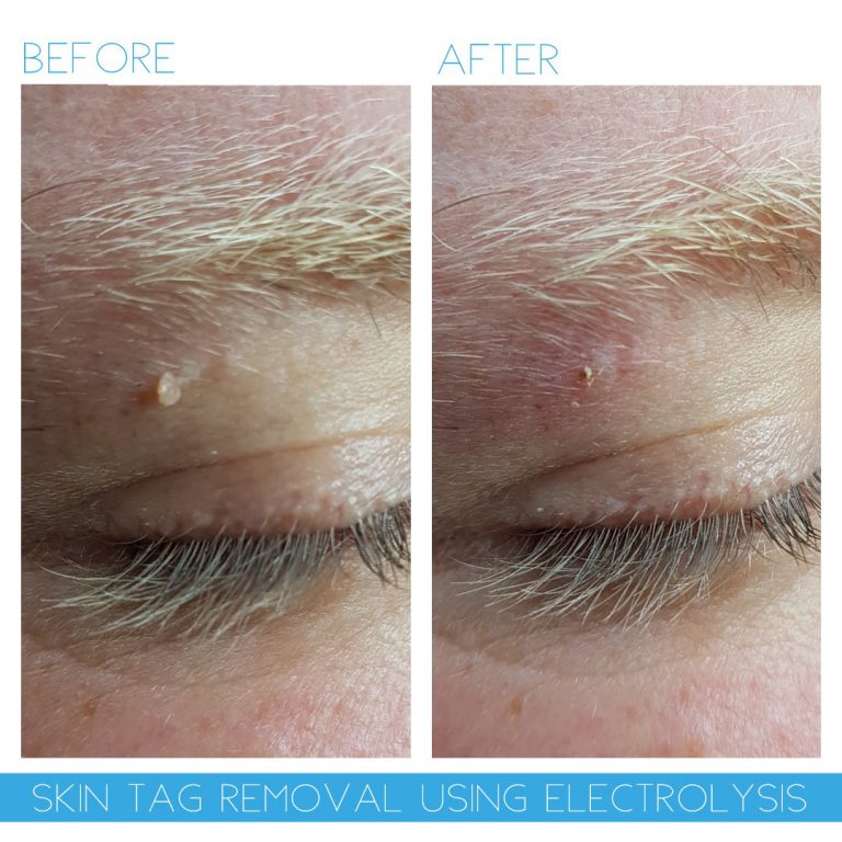 Electrolysis on bum cheeks Clearance