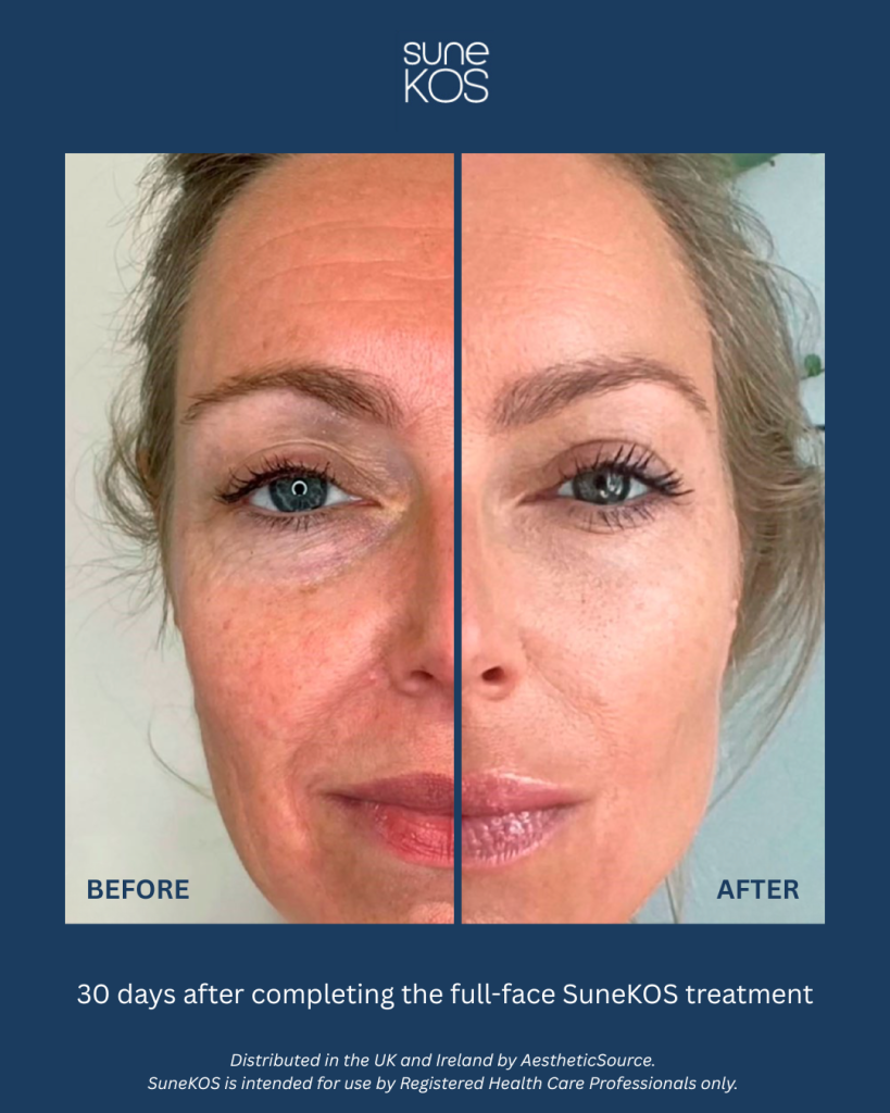 SuneKOS before and after Cheshire Lasers