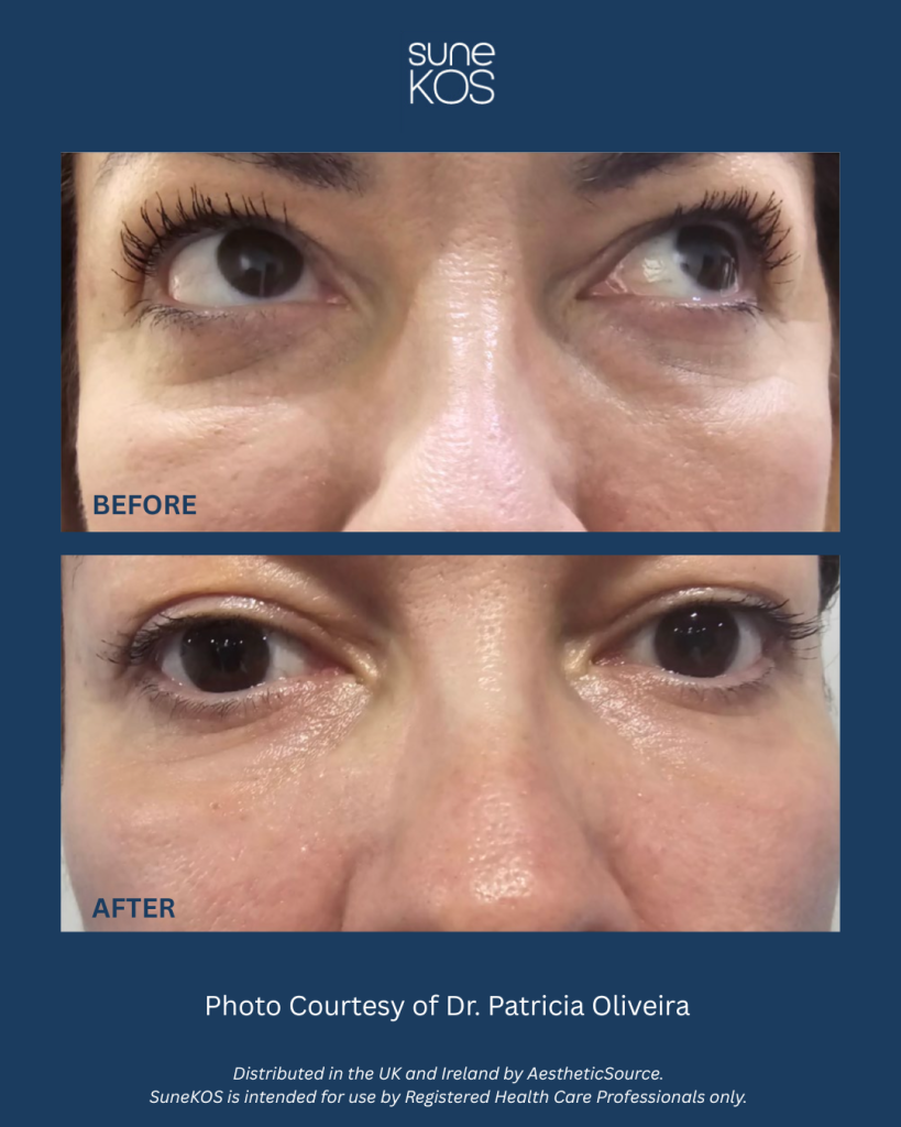 SuneKOS before and after Cheshire Lasers