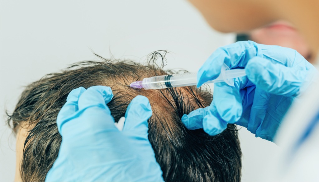 Hair Loss Treatments at Cheshire Lasers, Middlewich.