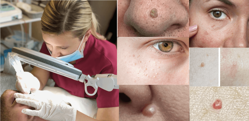skin lesion blemish removal middlewich Cheshire 