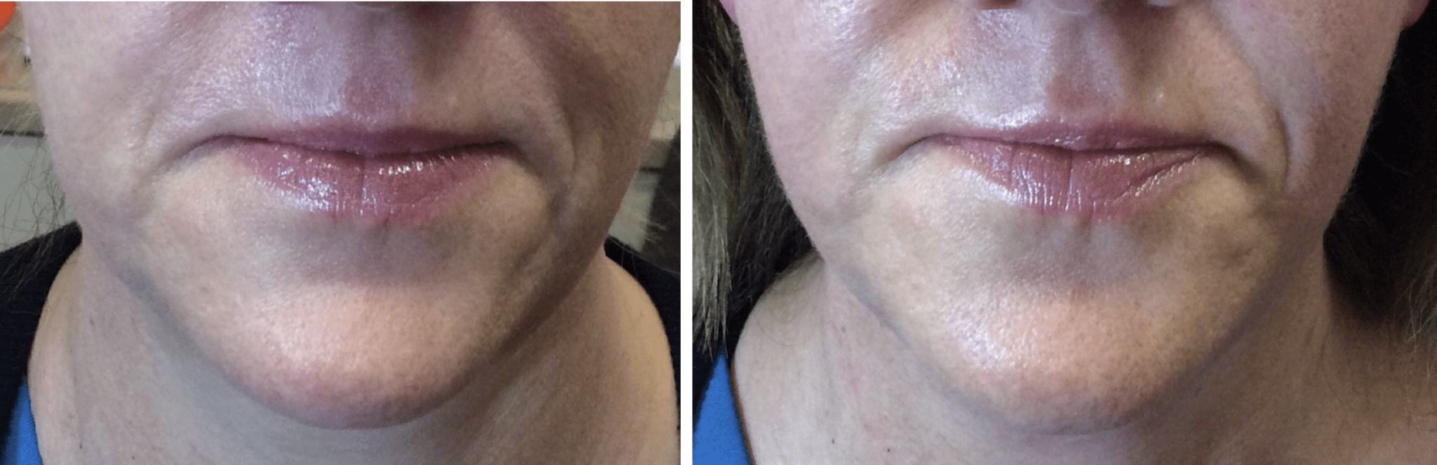 Info about Endymed Jawline Shaper treatment fantastic for jowls