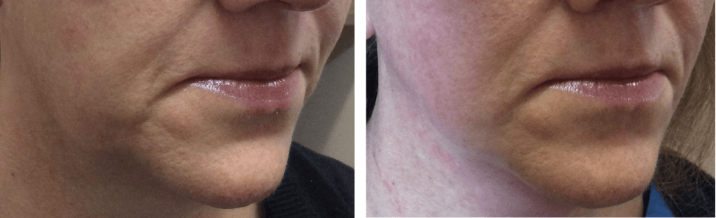 before and after endymed jawline mini shaper treatment cheshire