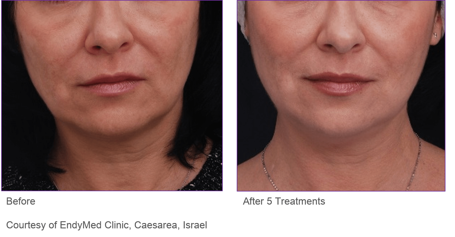 Info about Endymed Jawline Shaper treatment fantastic for jowls