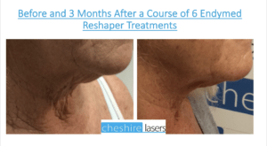 Ultraformer Jowl Treatment