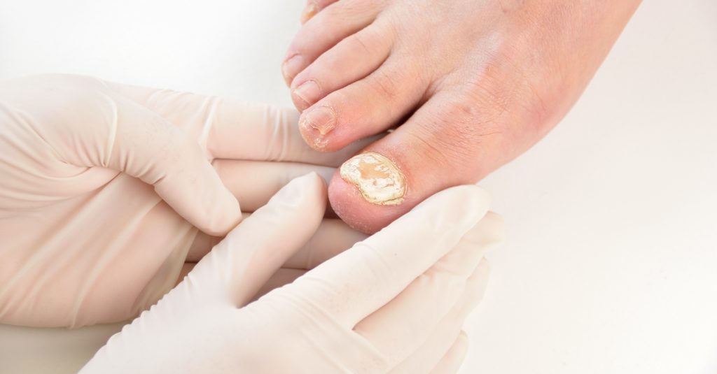 lacuna fungal nail treatment