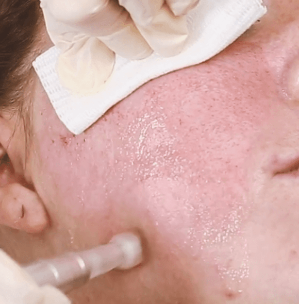 EDS Dermapen microneedling treatment Cheshire Lasers Middlewich