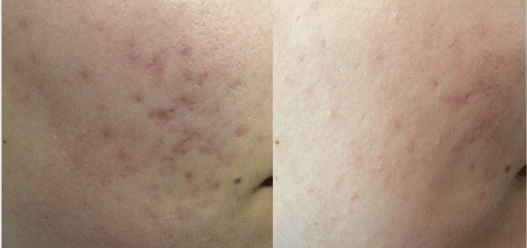 carboxytherapy acne scar treatment