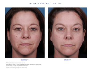 Blue Peel radiance Before After