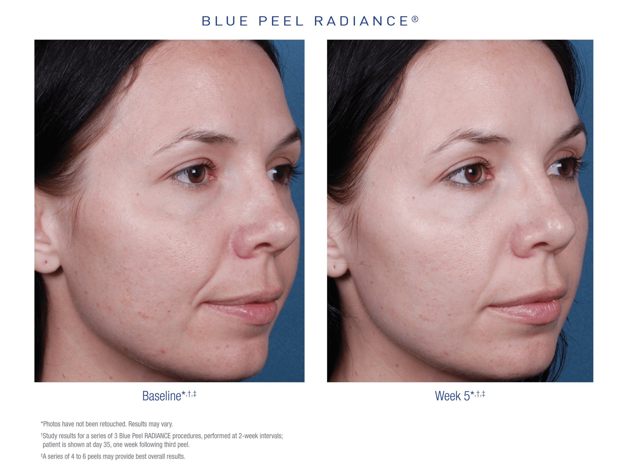 Obagi Blue Peel Radiance at Cheshire Lasers, Middlewich.