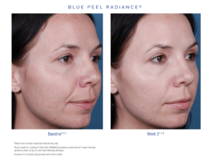 Blue Peel radiance Before After