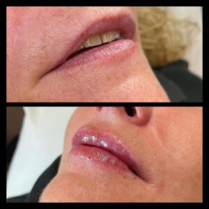 lip enhancement by Katey at Cheshire Lasers Clinic Middlewich
