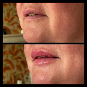 lip enhancement by Katey at Cheshire Lasers Clinic Middlewich