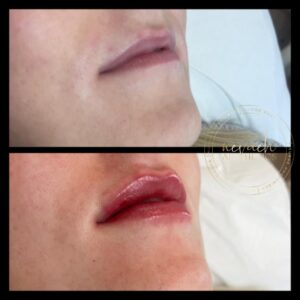 before and after lip dermal filler Middlewich Cheshire