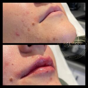 before and after lip dermal filler Middlewich Cheshire