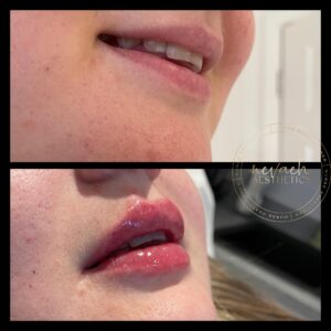 before and after lip dermal filler Middlewich Cheshire