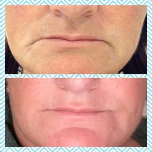 Dermal Filler marionette