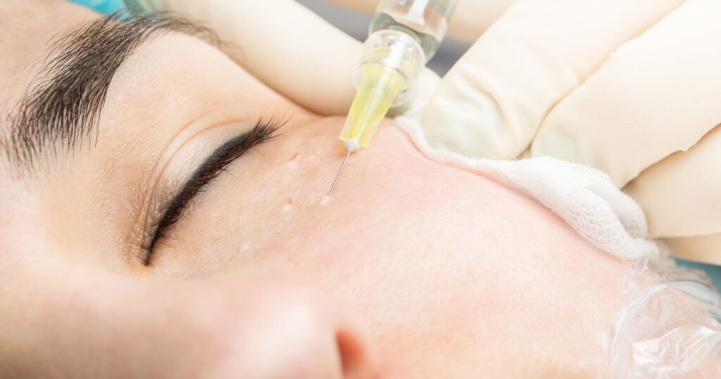 Eye Clips For Injection Find out about the range of under eye injectables available.
