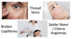 red vein treatment