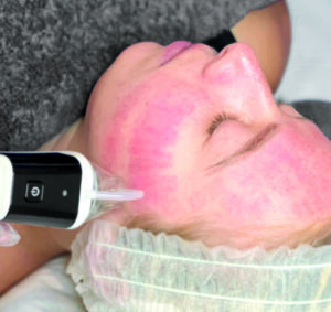 during a RF microneedling treatment