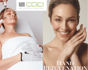 CACI hand rejuvenation treatment