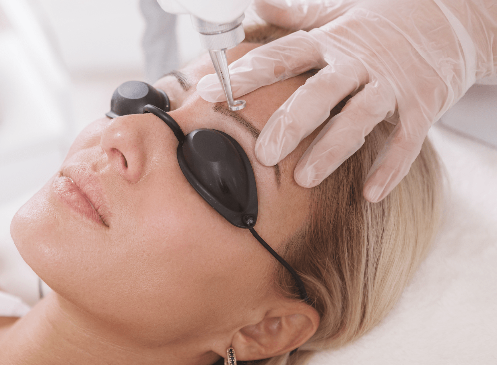 laser semi permanent eyebrow removal