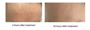 skin appearance after an RF microneedling treatemnt