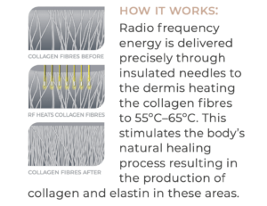 how RadioFrequency Microneedling Works