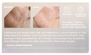 before and after RadioFrequency Microneedling