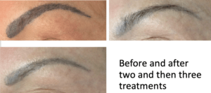 laser eyebrow treatments Cheshire