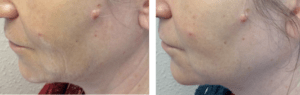 before and after RF microneedling treatment