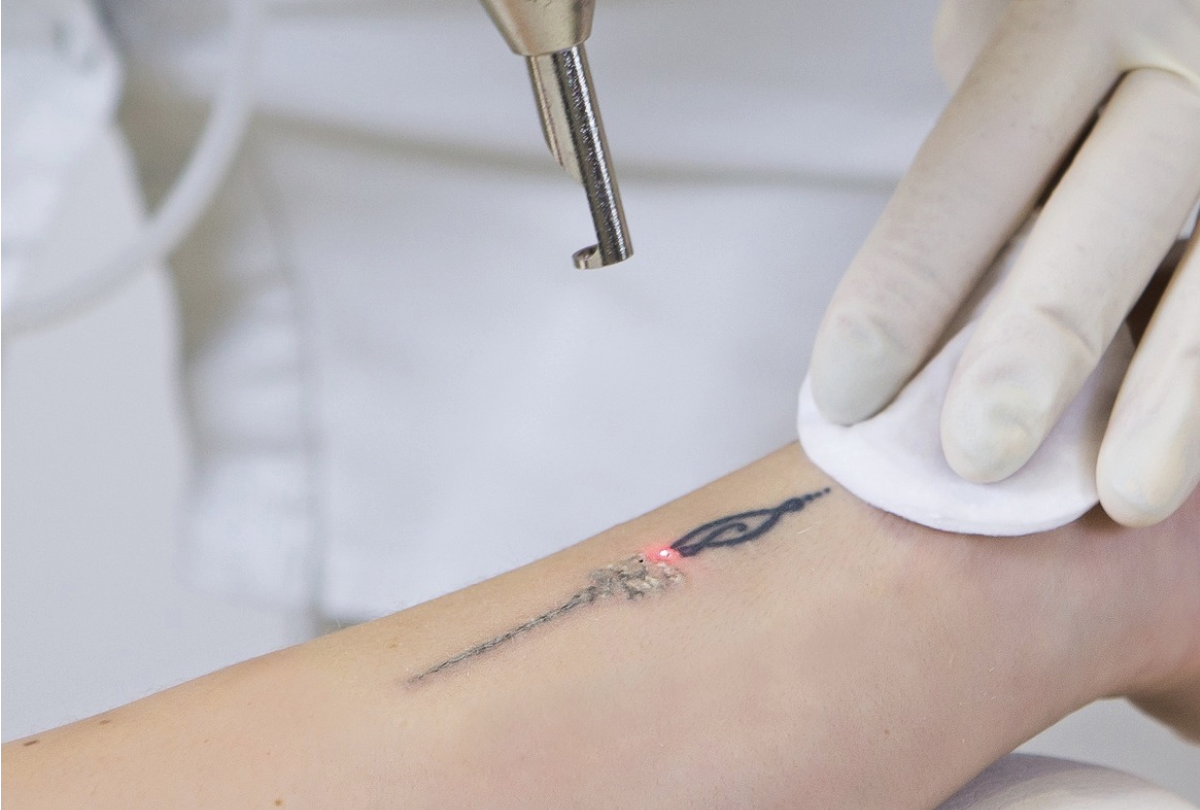 Laser Tattoo Removal Cheshire