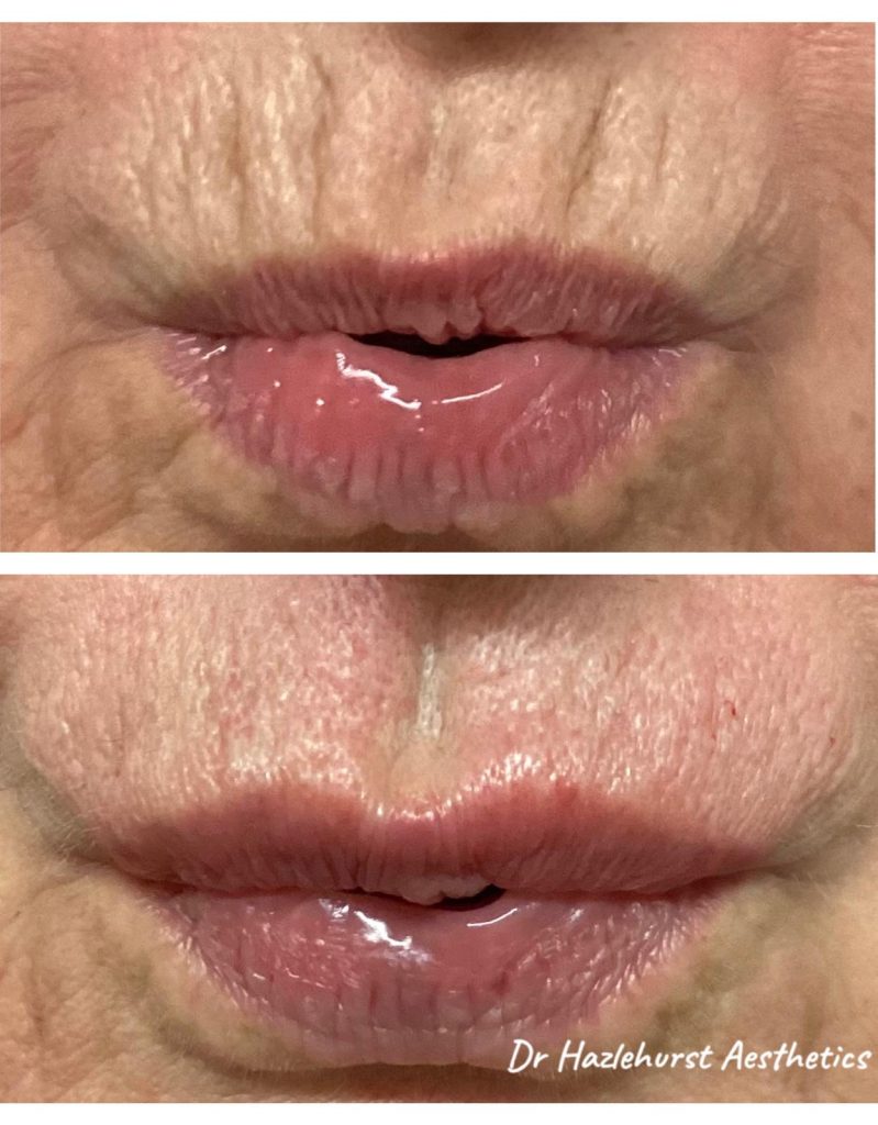 Lip rejuvenation by Dr Hazlehurst