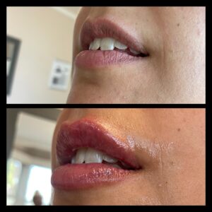 Before and After Lip Enhancement with Dermal Fillers by Katey Moulton