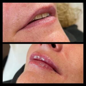 Before and After Lip Enhancement with Dermal Fillers by Katey Moulton