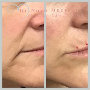 Marionette line treatment Cheshire Dr Drinnan