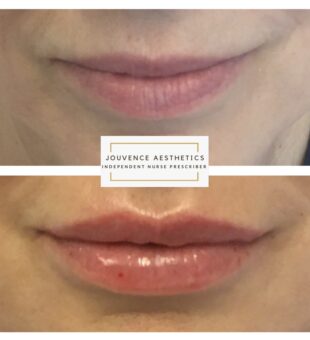 Belotero Lip enhancement Middlewich Cheshire