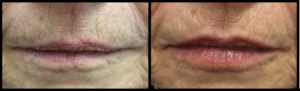 Before and After Lip Rejuvenation by Dr Teri Johnson