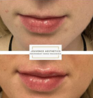 Belotero Lip enhancement Middlewich Cheshire