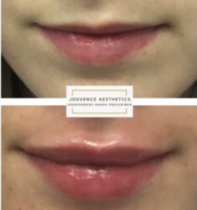 Belotero Lip enhancement Middlewich Cheshire