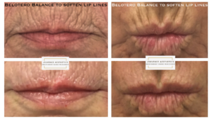 Belotero Balance to Soften Lip Lines Middlewich Cheshire