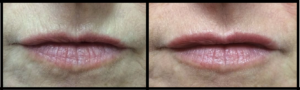 Before and After Lip Rejuvenation by Dr Teri Johnson Dr Teri Johnson Middlewich Cheshire